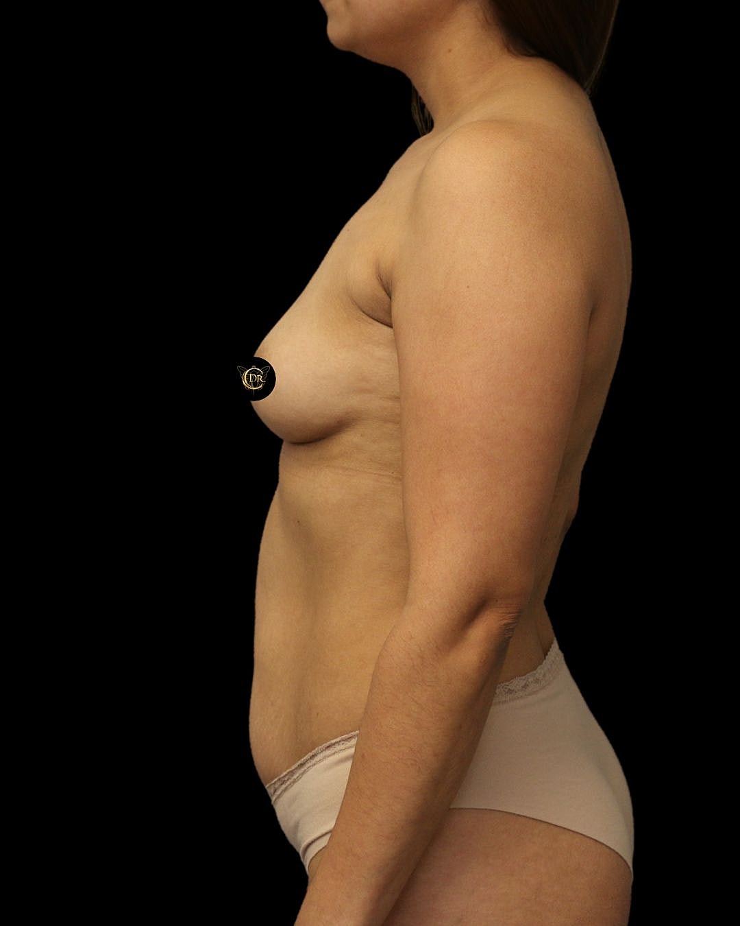 Abdominoplasty Before & After
