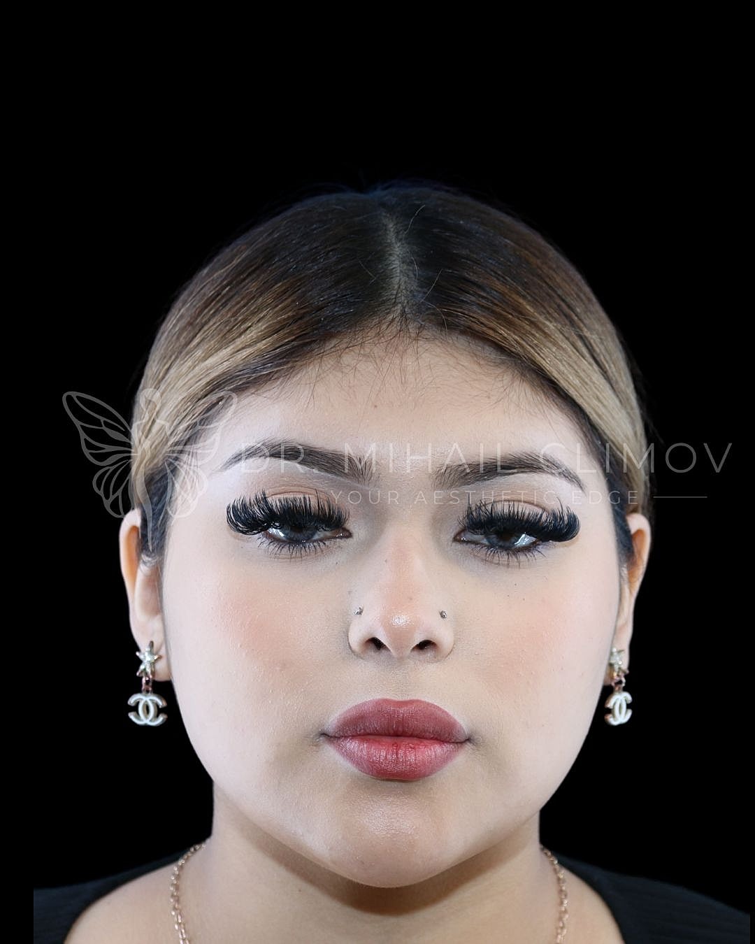 Female neck liposuction after photo, front view, showing slim neckline and defined jawline following double chin removal in Houston, TX.