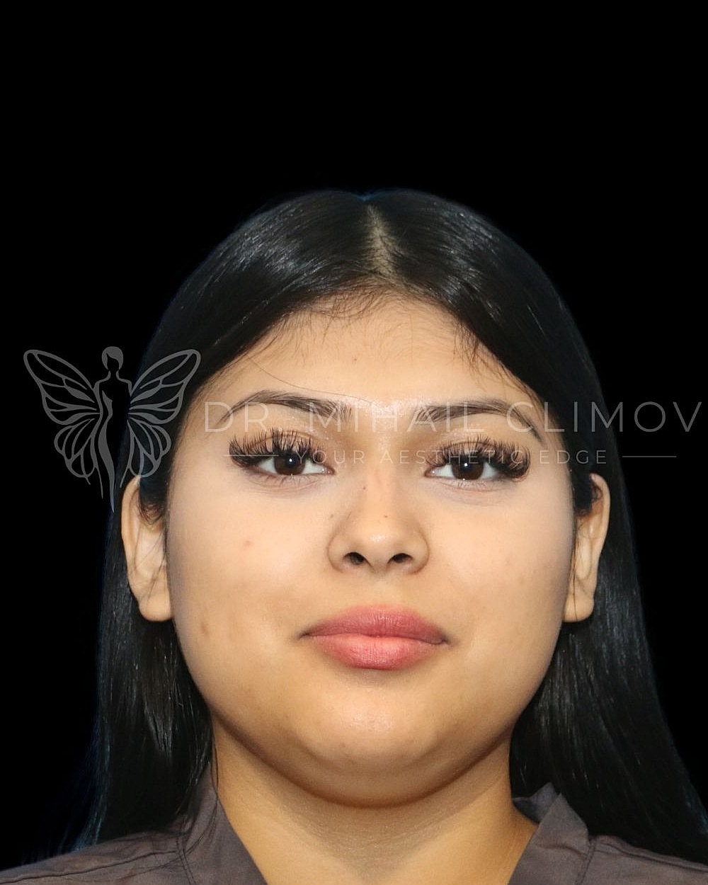 Female neck liposuction before photo, front view, showing under-chin fullness and soft jawline prior to double chin removal in Houston, TX.