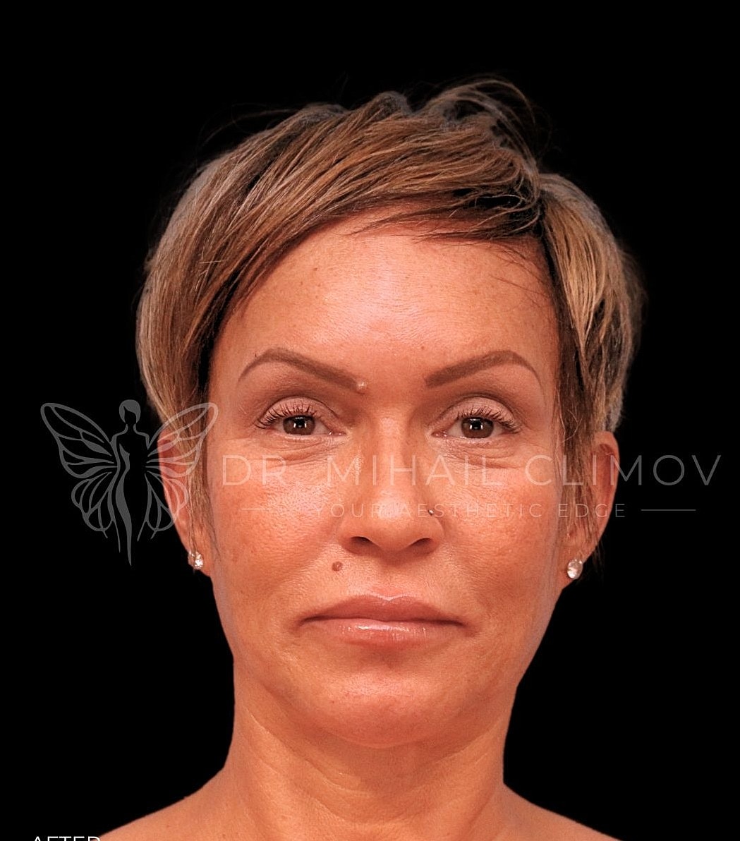 Female submental liposuction after photo, front view, showing defined jawline and smooth neck contour following cosmetic neck contouring in Houston, Texas.