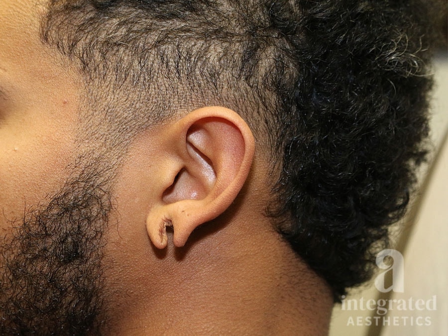 Earlobe Repair Before & After