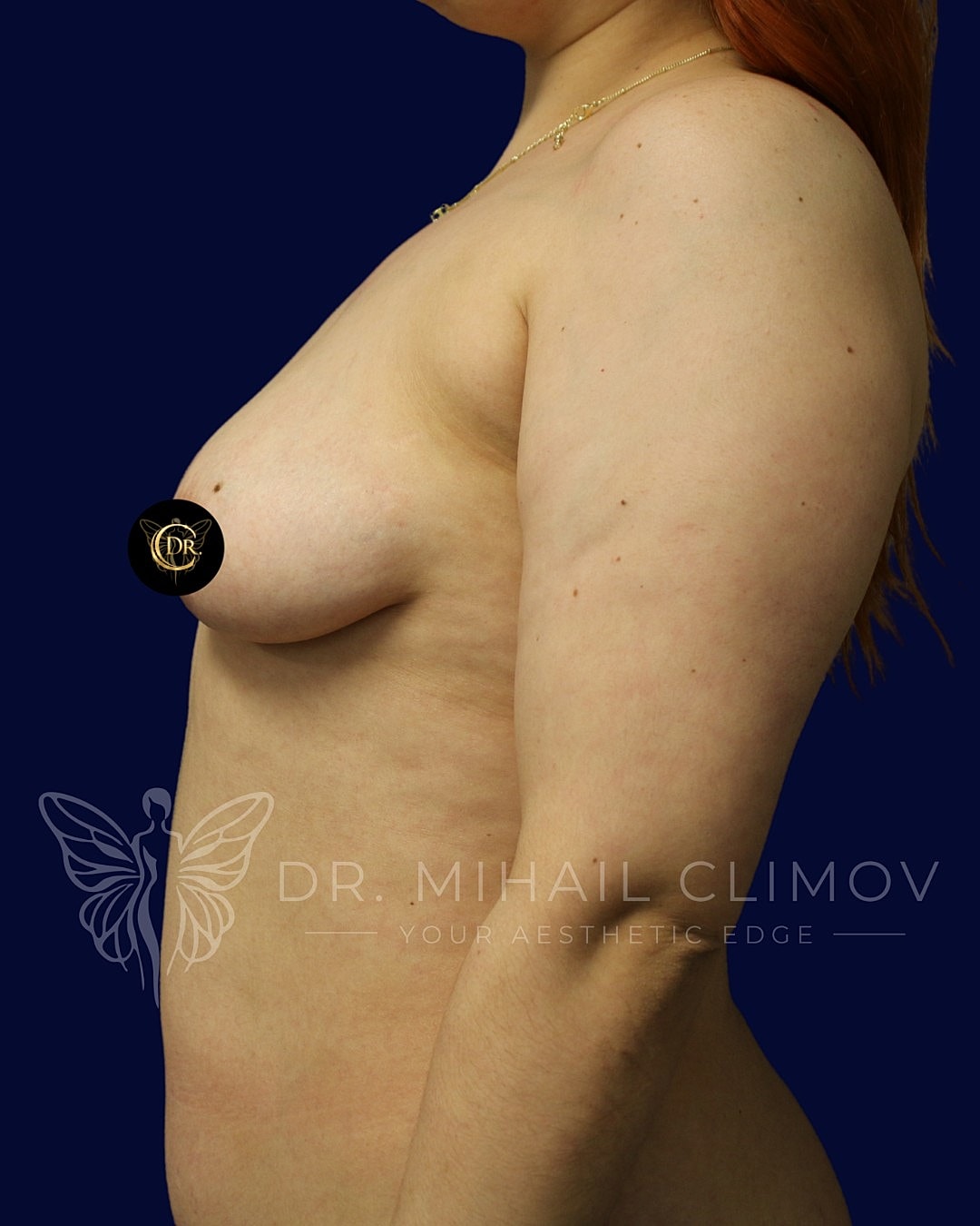 Tuberous Breast Correction Before & After