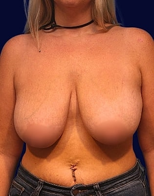 Breast Reduction Before & After