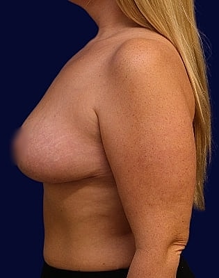 Breast Reduction Before & After