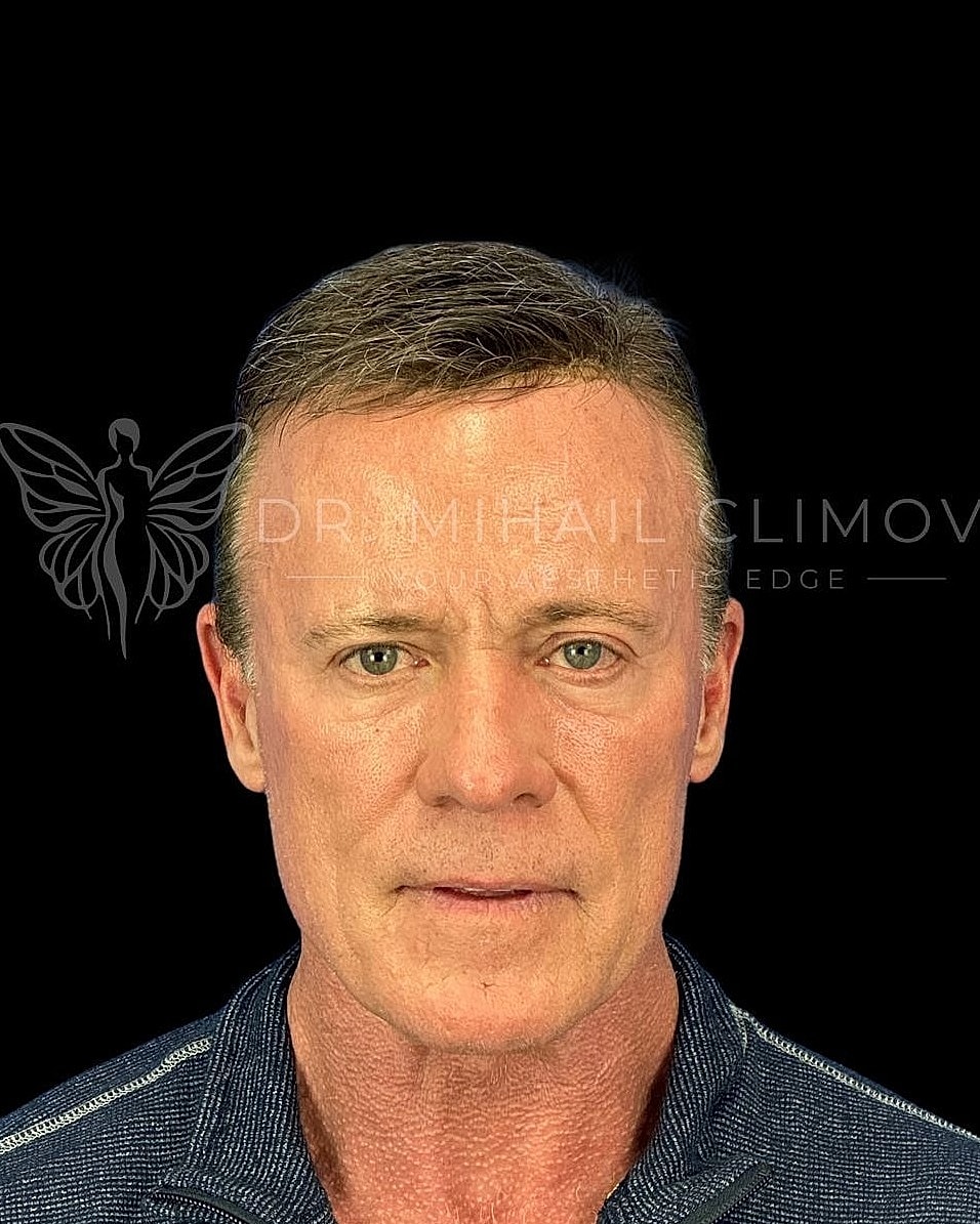 Male lower eyelid blepharoplasty after photo, front view, showing smooth under-eye contour following cosmetic eyelid surgery in Houston, Texas.