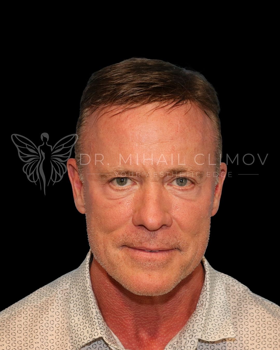 Male lower eyelid blepharoplasty before photo, front view, showing puffy lower lids prior to cosmetic eyelid surgery in Houston, TX.