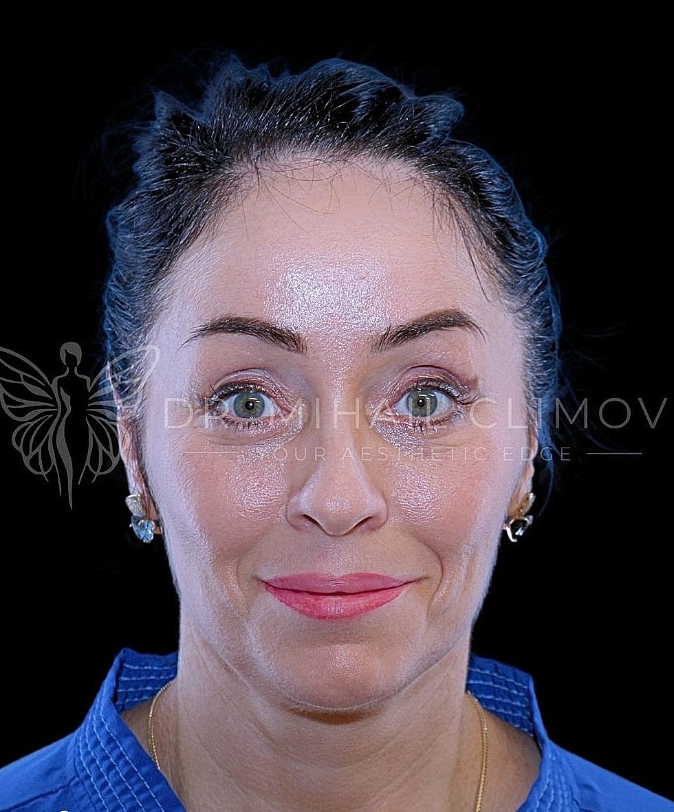Lower blepharoplasty after photo, front view, showing under-eye bags prior to surgery by Dr. Mihail Climov in Houston, TX.