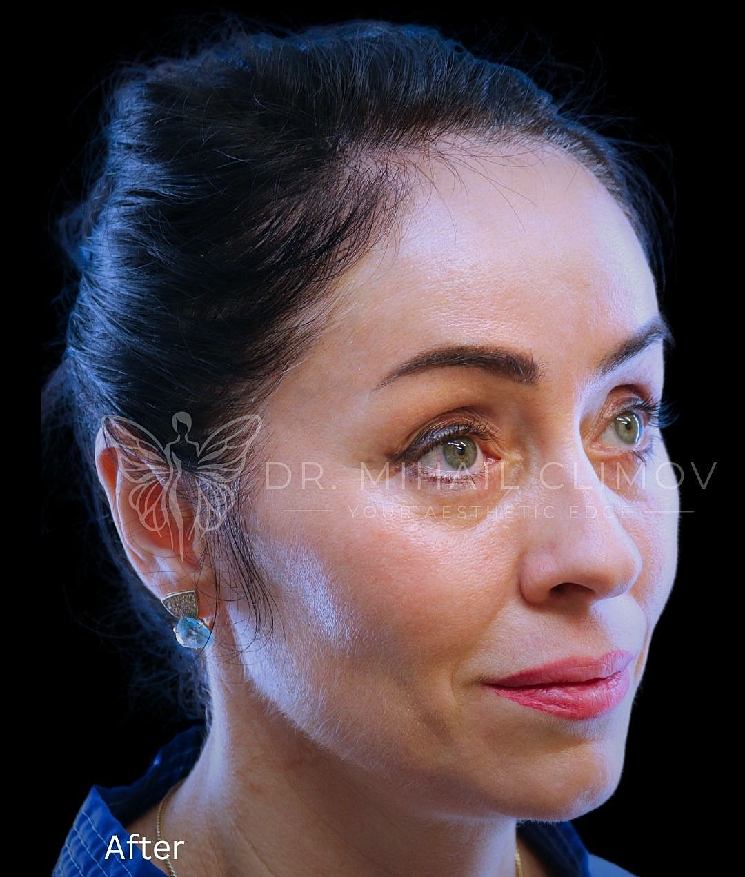 Lower blepharoplasty after photo, oblique view, showing smooth under-eye results after surgery by Dr. Climov in Houston, Texas.
