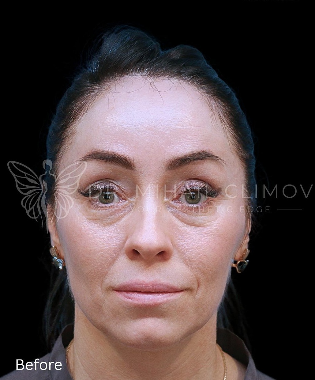 Lower blepharoplasty before photo, front view, showing under-eye bags prior to surgery by Dr. Mihail Climov in Houston, TX.