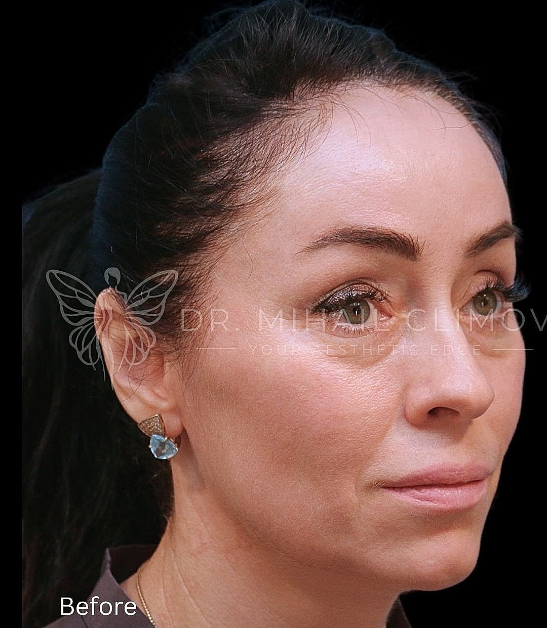 Lower blepharoplasty before photo, oblique view, showing under-eye puffiness and skin laxity before surgery by Dr. Climov in Houston.