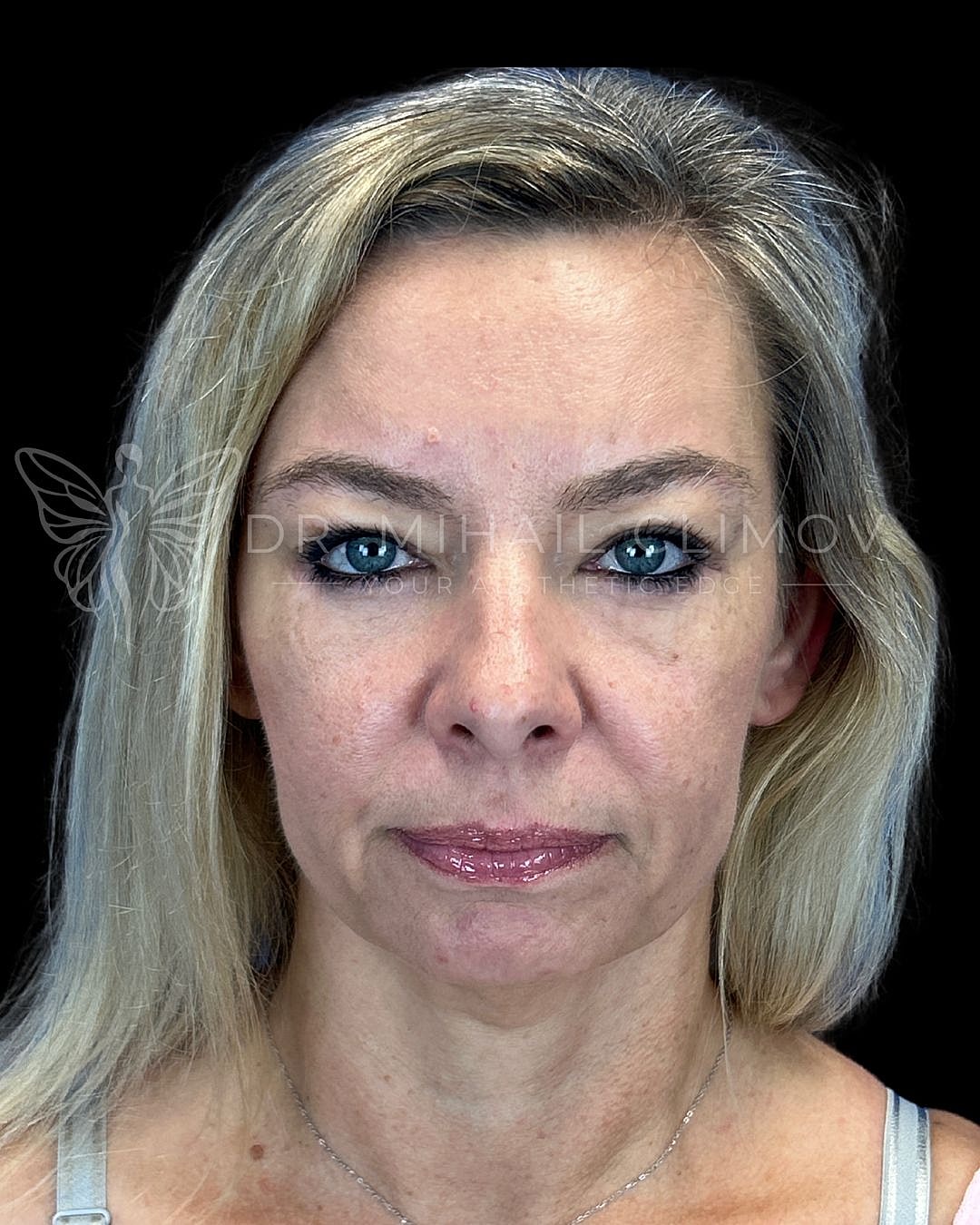 Female lower eyelid blepharoplasty after photo, front view, showing smooth under-eye contour and refreshed appearance following cosmetic eyelid surgery in Houston, Texas.
