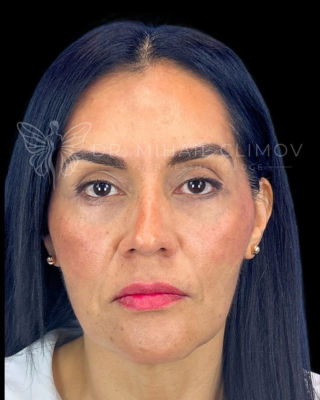 Front view after lower eyelid surgery showing smooth under-eye contour and refreshed appearance, patient of Dr. Mihail Climov in Houston, TX.