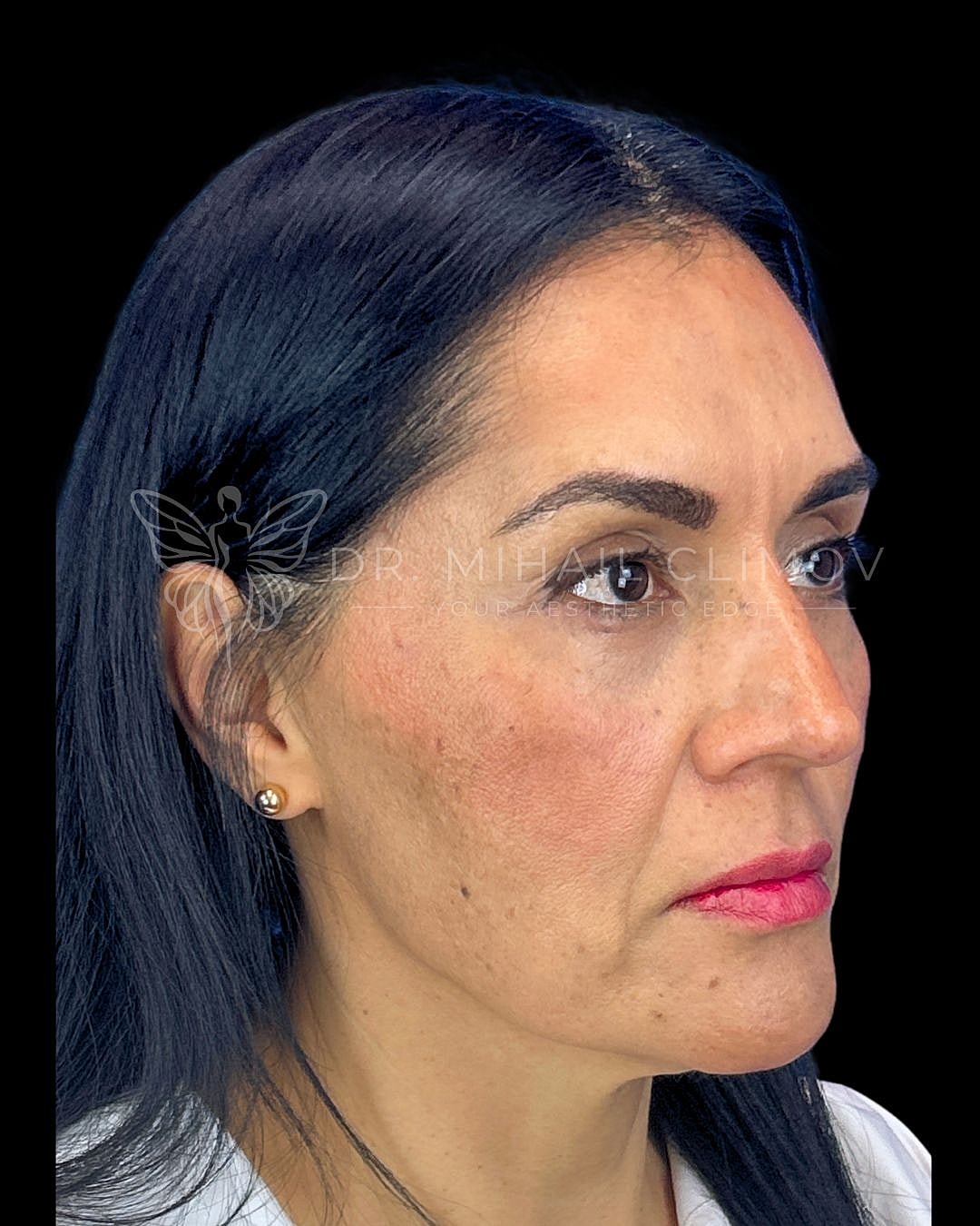 Left oblique view after lower eyelid surgery showing restored under-eye smoothness and rejuvenated contour, patient of Dr. Climov in Houston, TX.