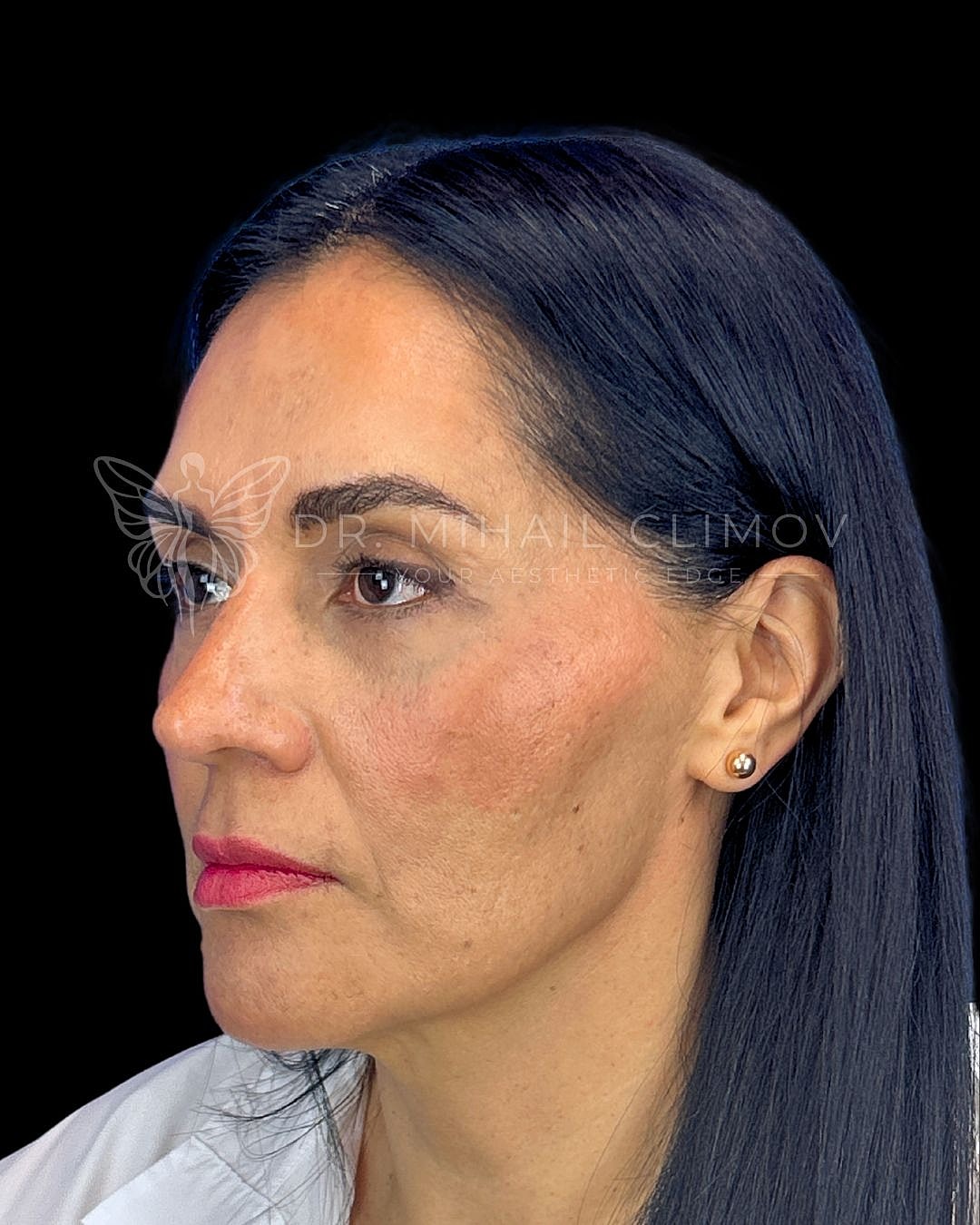 Right oblique view after lower blepharoplasty showing eliminated under-eye bags and youthful profile, patient of Dr. Mihail Climov in Houston.
