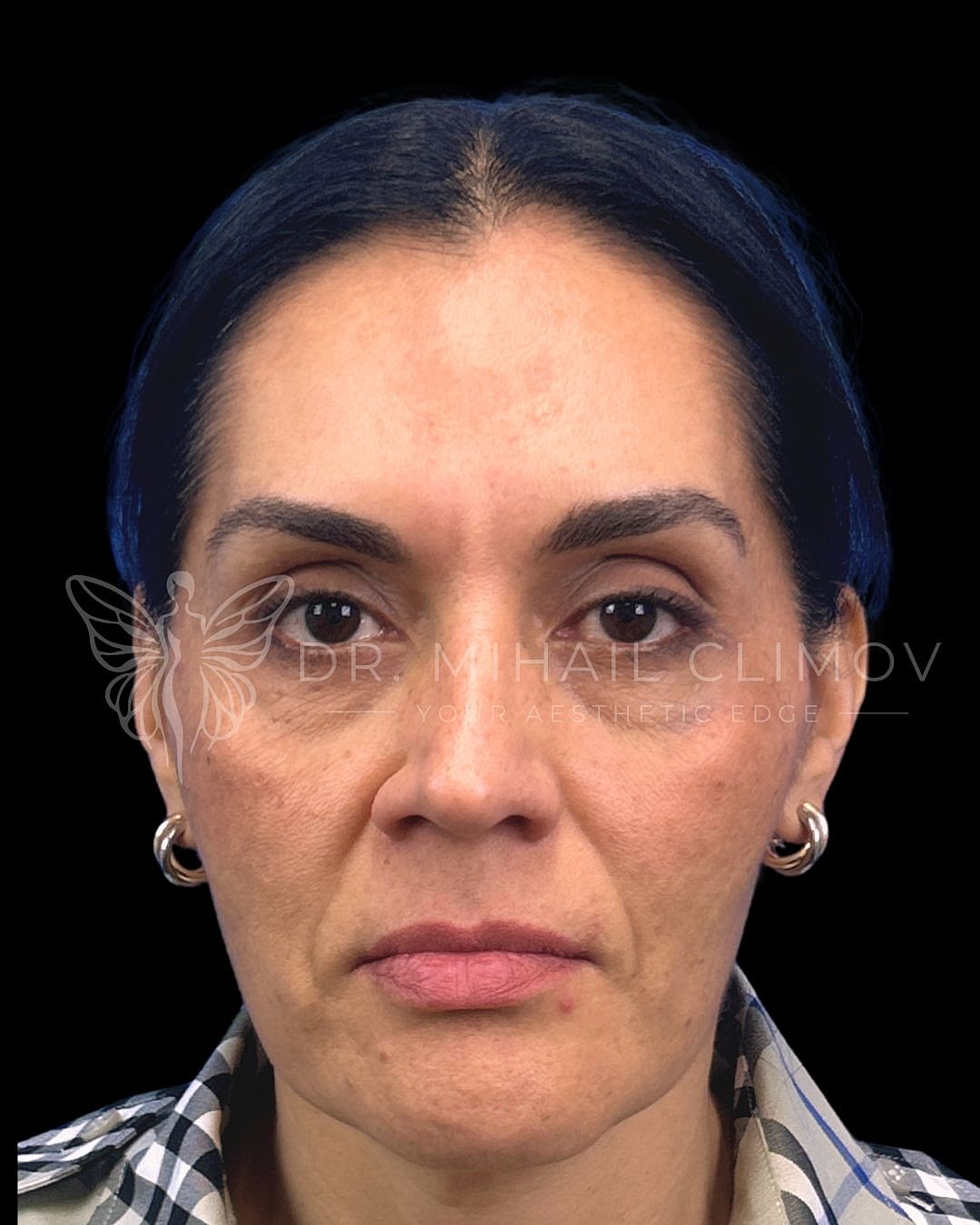 Front view before lower eyelid surgery showing dark circles and skin laxity, patient of Dr. Mihail Climov in Houston, Texas.
