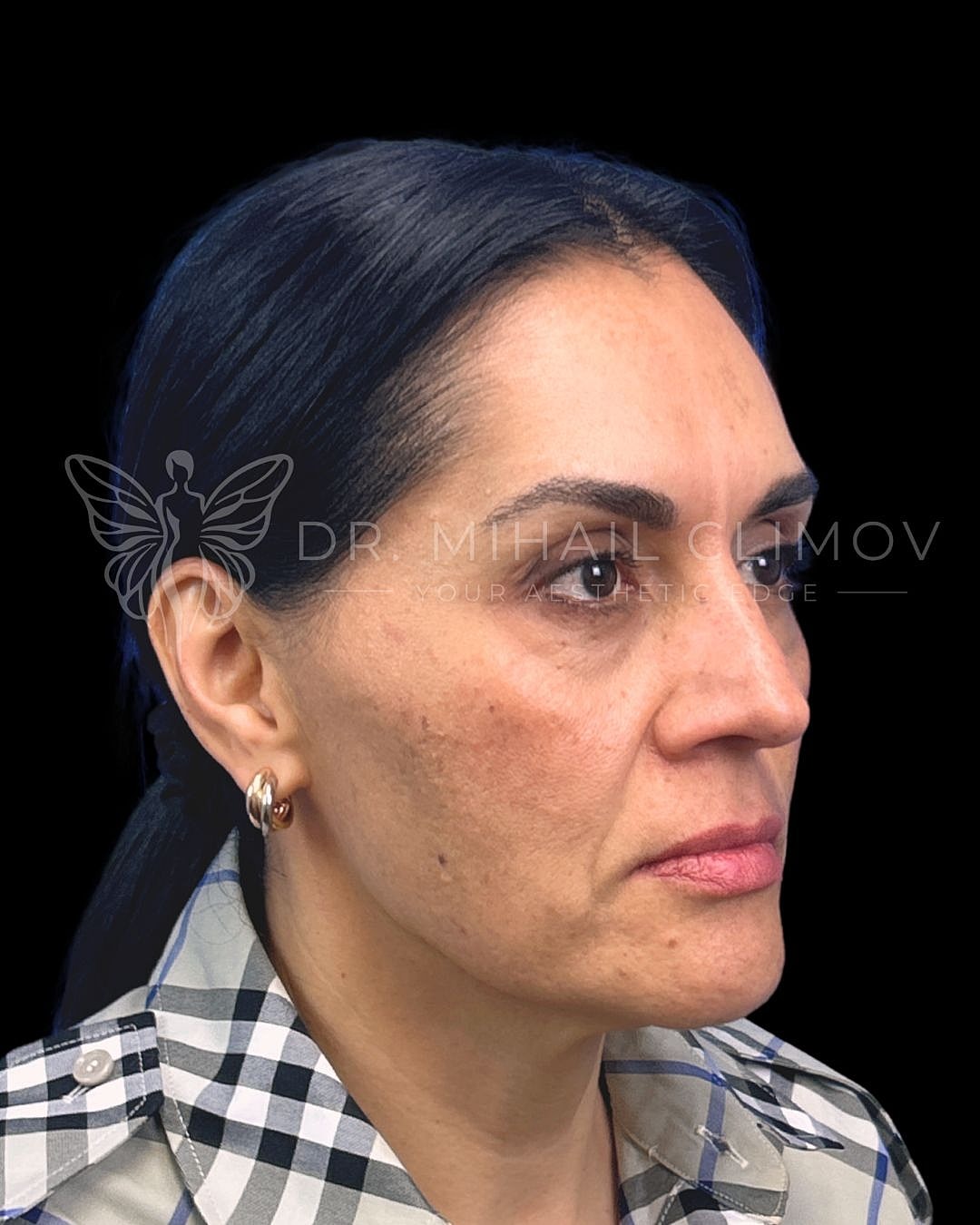 Left oblique view before lower eyelid surgery showing under-eye hollowing and tired appearance, patient of Dr. Climov in Houston, Texas.