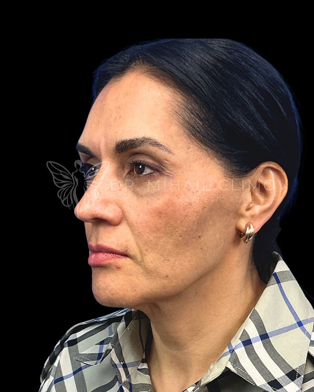 Right oblique view before lower blepharoplasty showing puffy lower lids and shadowing, patient of Dr. Mihail Climov in Houston.