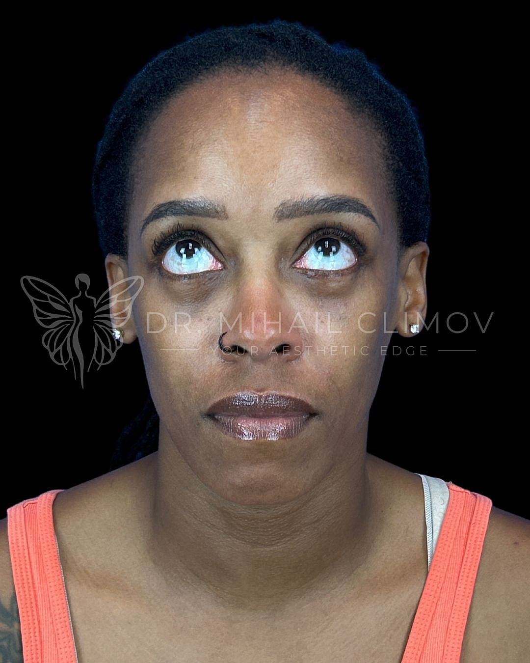 After lower blepharoplasty, front gaze-up view, showing improved lower eyelid contour and natural results after surgery by Dr. Climov in Houston, TX.