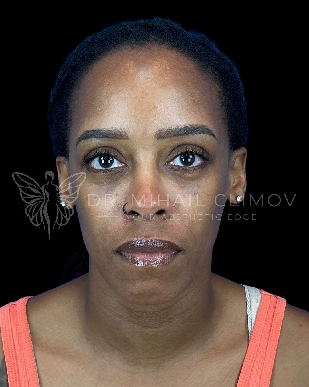 After lower blepharoplasty, front view, showing smooth under-eye contour and refreshed appearance following eyelid surgery by Dr. Climov in Houston.