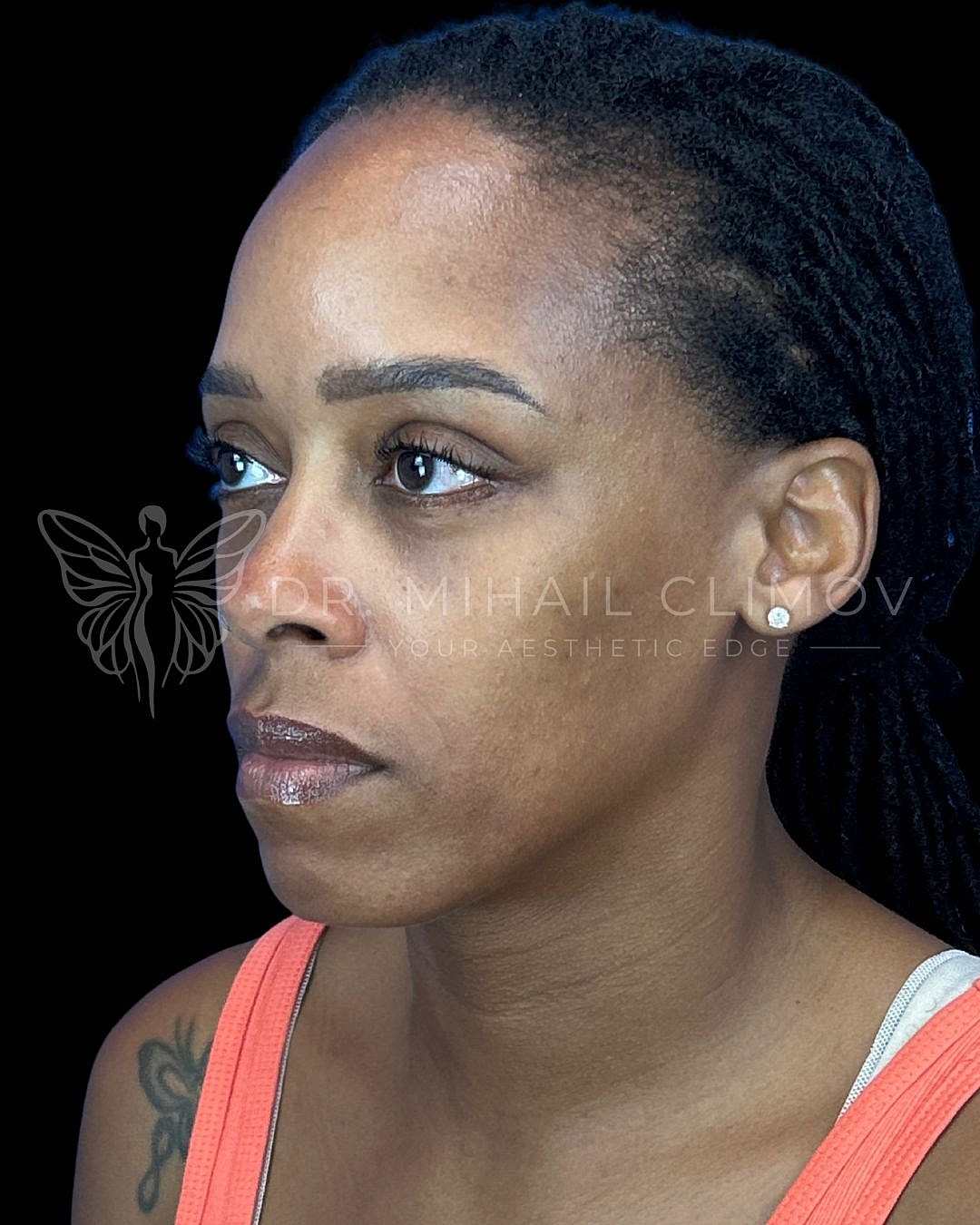 After lower blepharoplasty, right oblique view, showing eliminated under-eye bags and rejuvenated profile after eyelid surgery by Dr. Mihail Climov in Houston.