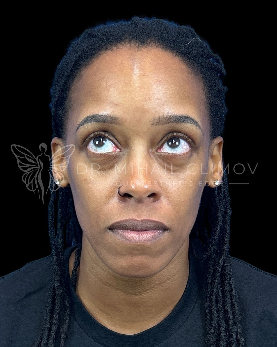 Before lower blepharoplasty, front gaze-up view, showing lower eyelid skin laxity and fat prolapse prior to surgery by Dr. Climov in Houston, TX.