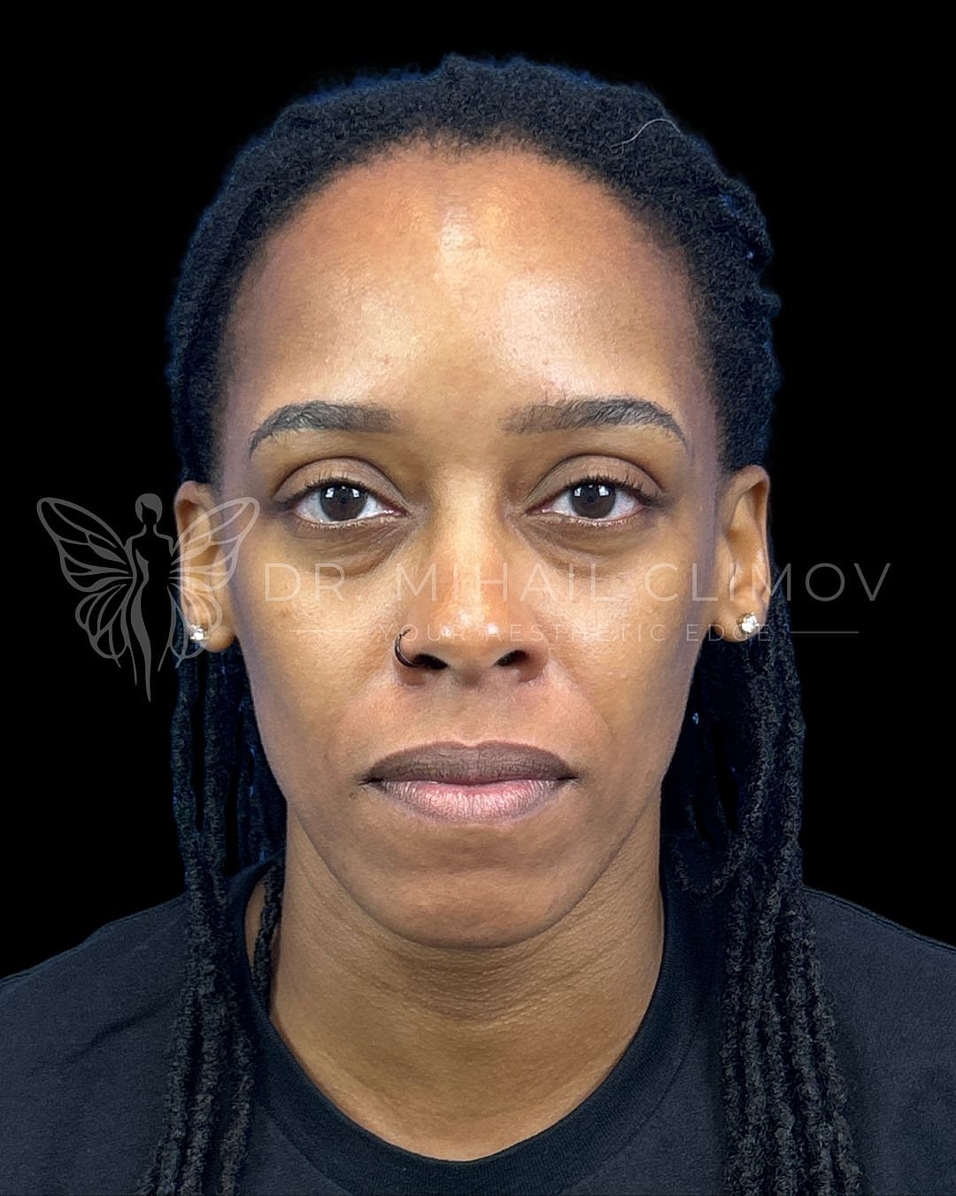 Before lower blepharoplasty, front view, showing under-eye puffiness and hollowing before eyelid surgery by Dr. Climov in Houston.