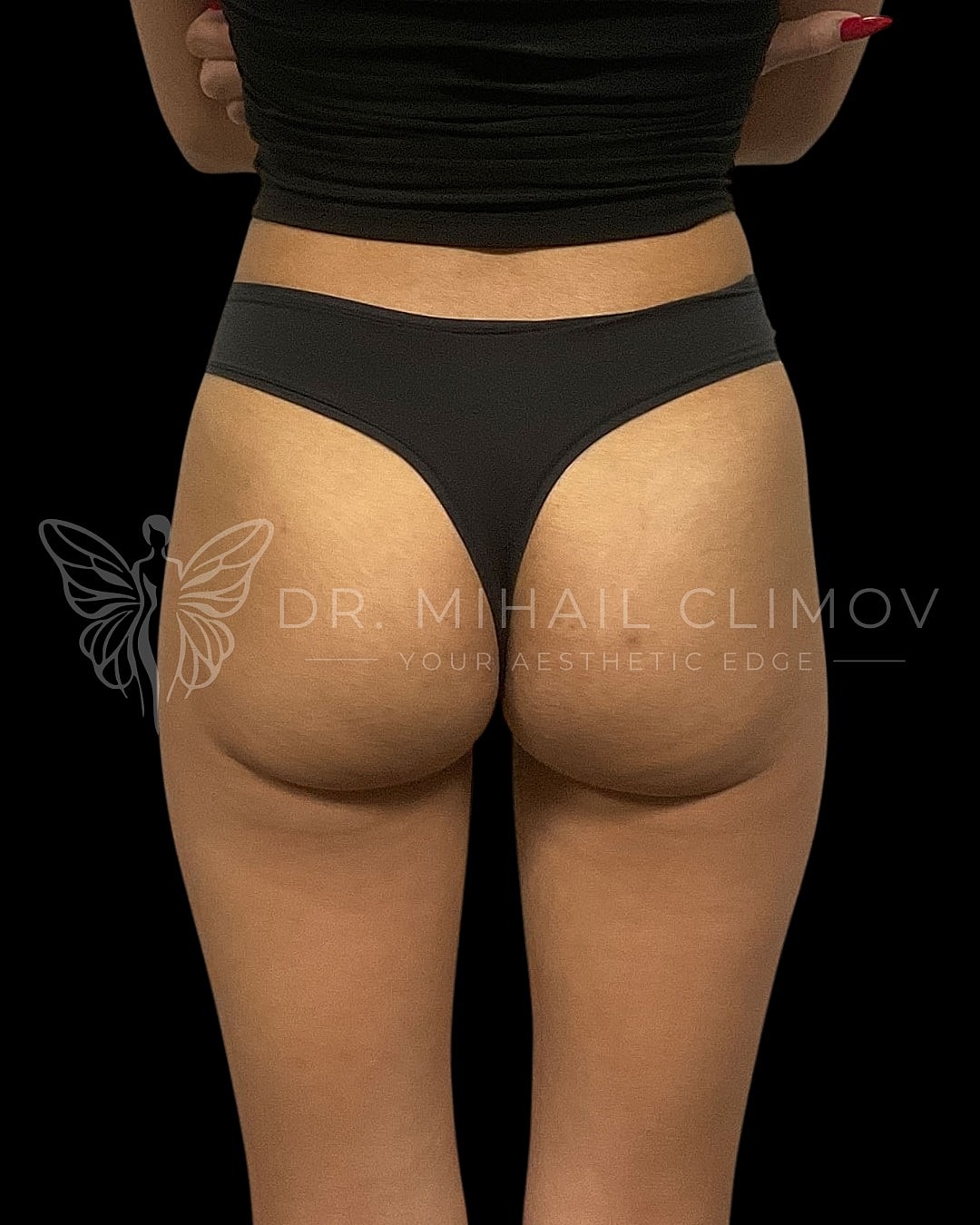 _before_front.png Before BBL (Brazilian butt lift) surgery – front view – Dr. Mihail Climov, Aesthetic Plastic Surgeon, Houston, TX