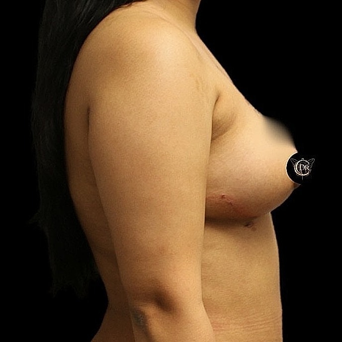 Breast lift before and after Houston