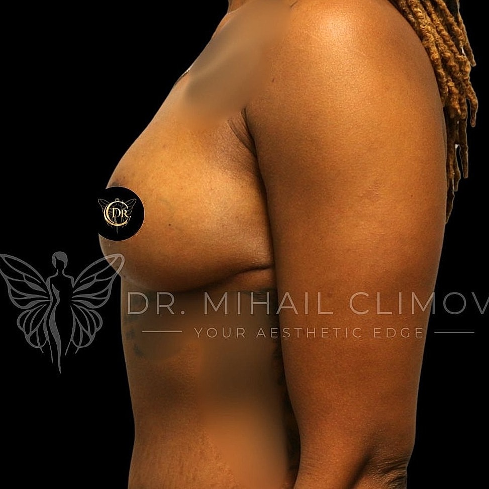 Breast Lift Before & After