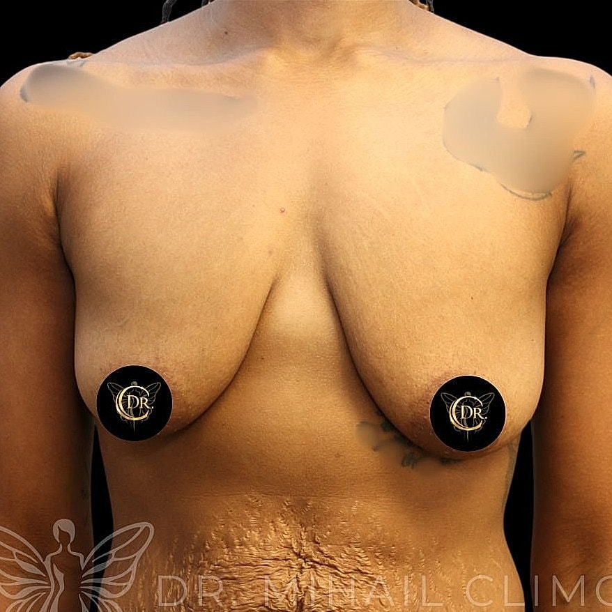 Breast Lift Before & After