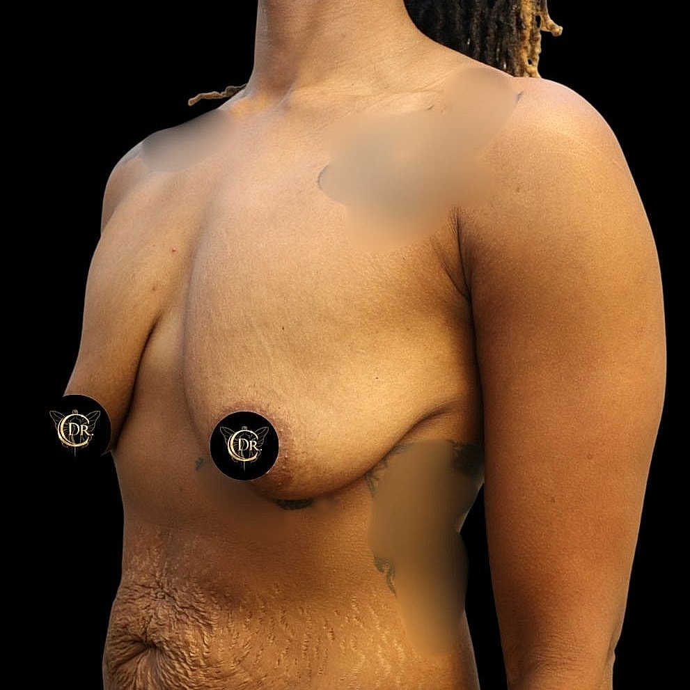 Breast Lift Before & After