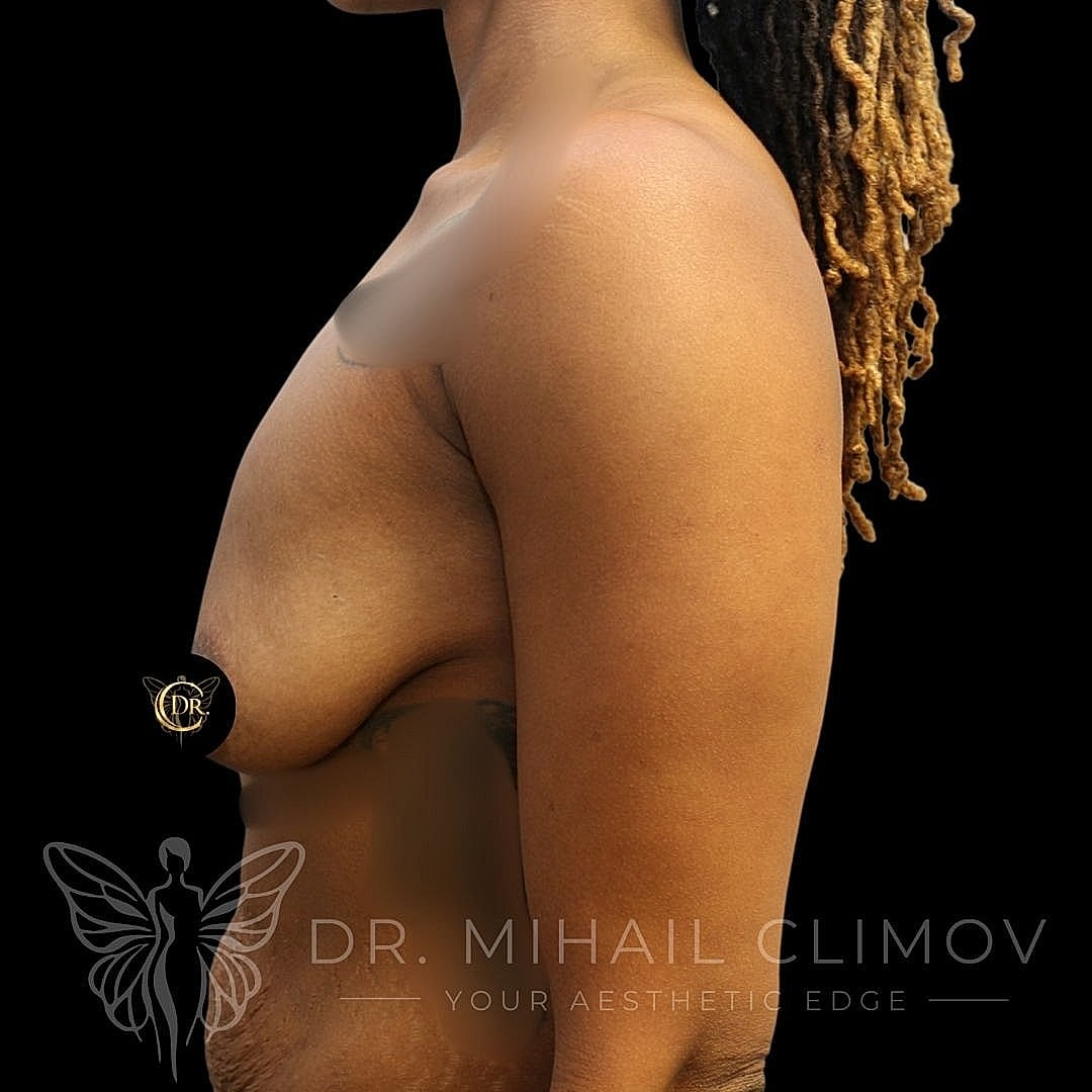 Breast Lift Before & After