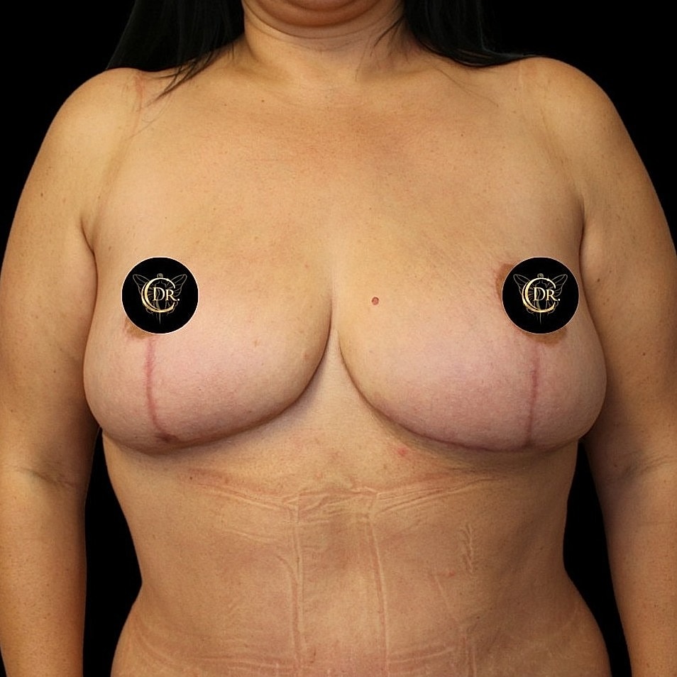 Breast Lift Before & After