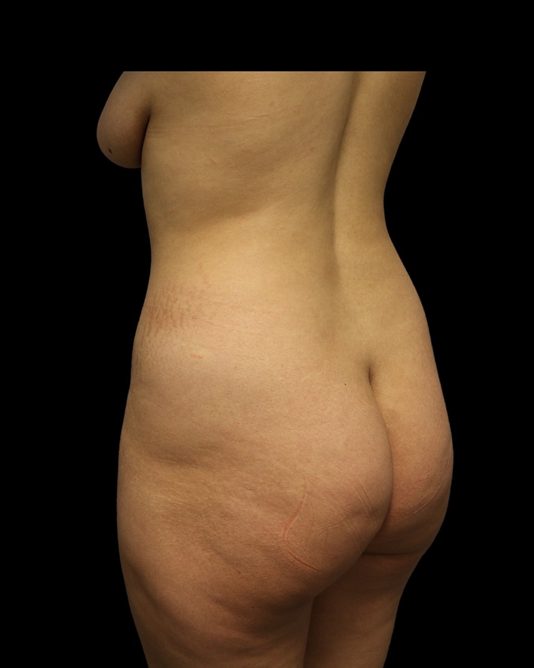Liposuction Before & After