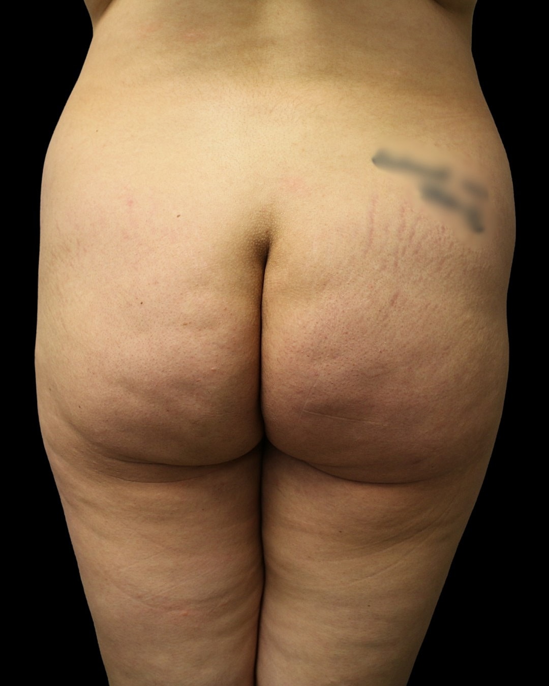 Liposuction Before & After