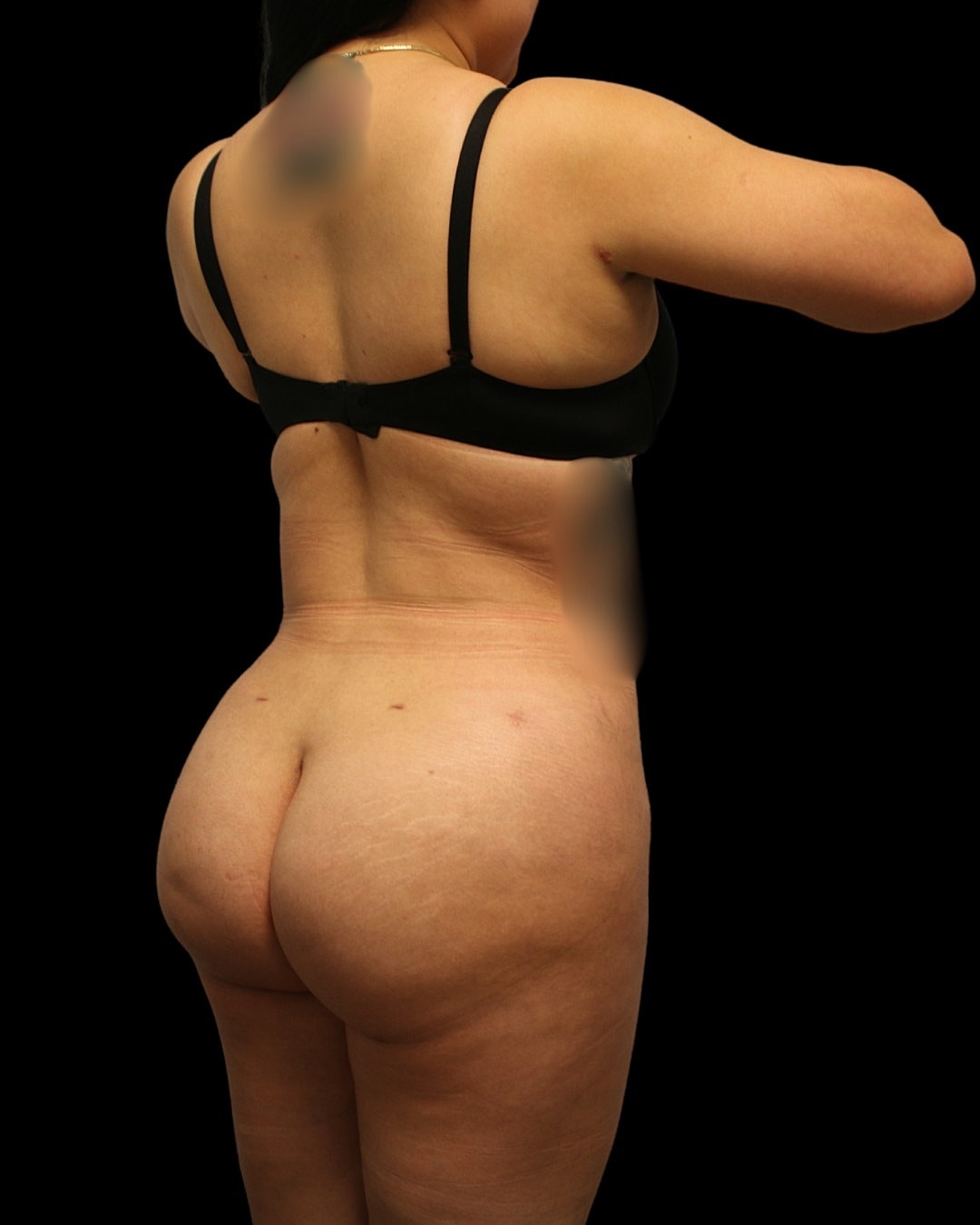 360 liposuction and bra-line liposuction results