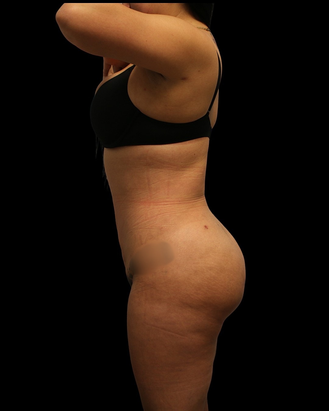 Circumferential liposuction before and after