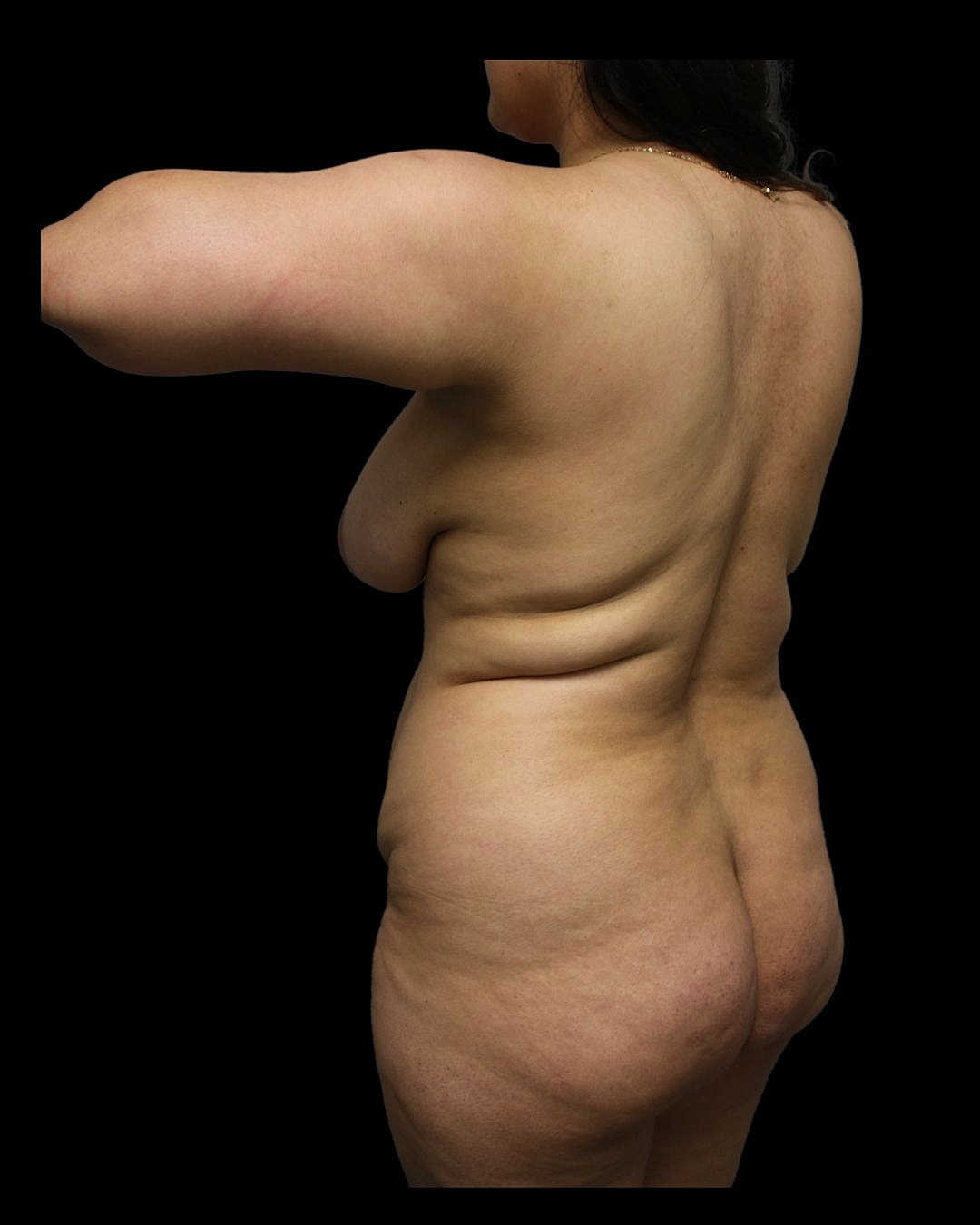 Liposuction Before & After
