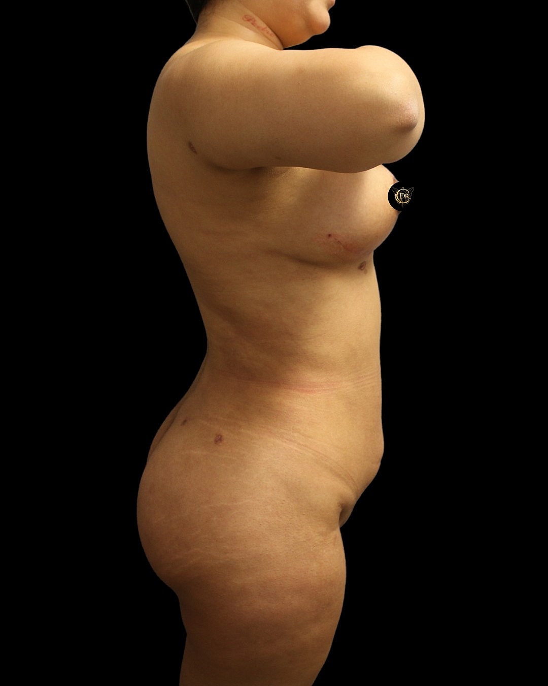Power-assisted liposuction and Renuvion results