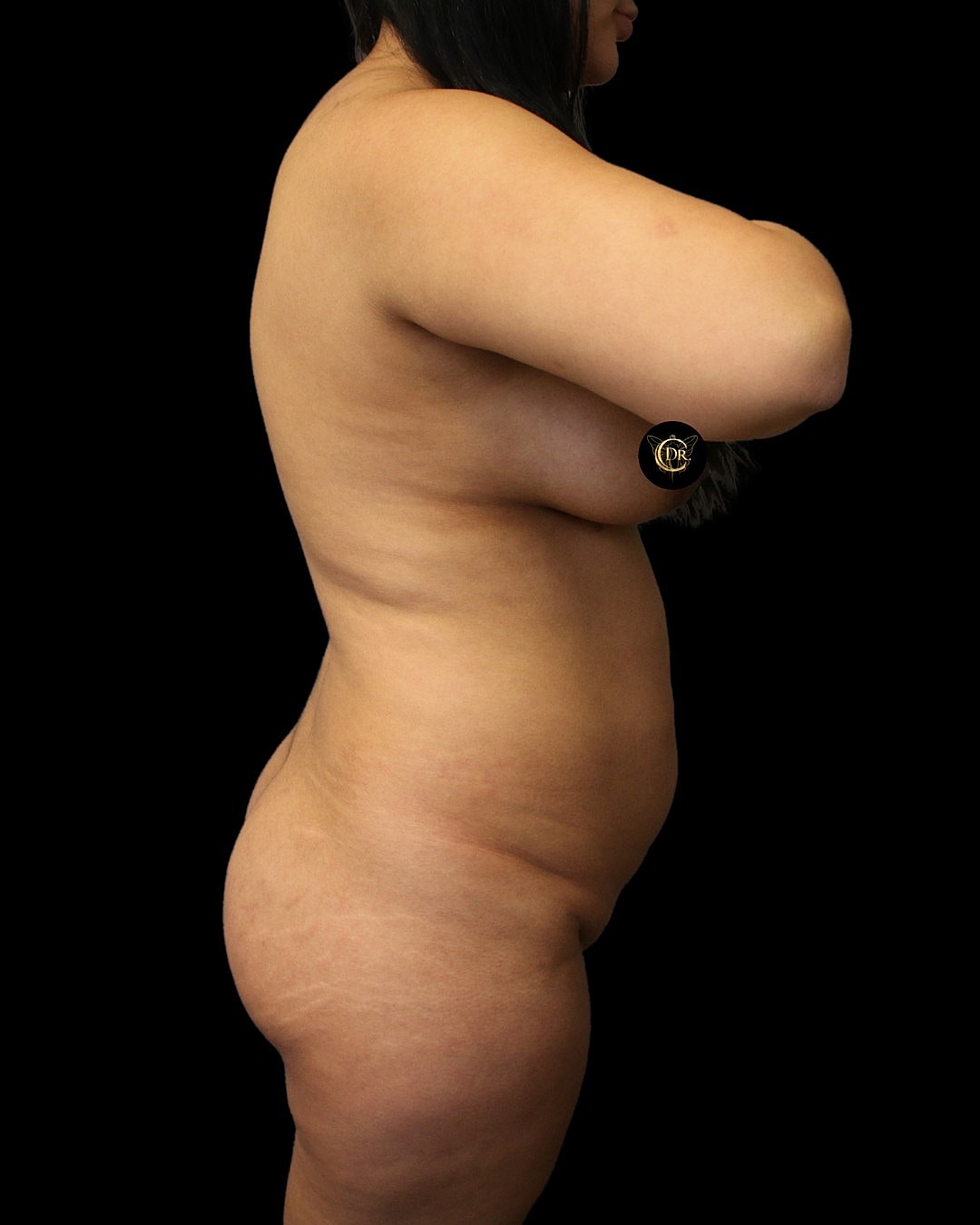 Power-assisted liposuction and Renuvion results