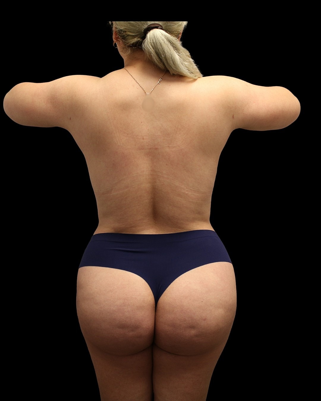 Liposuction Before & After
