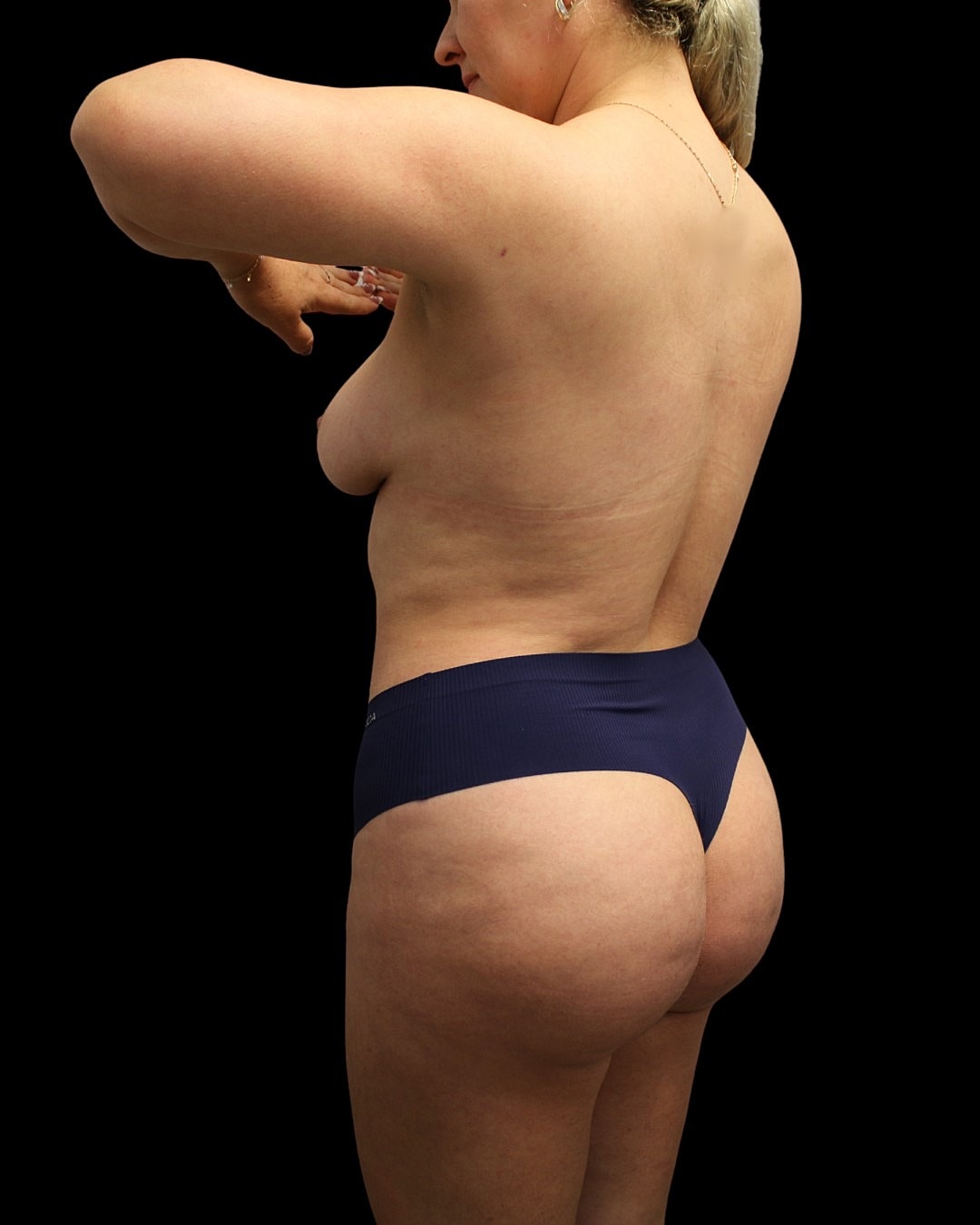 Liposuction Before & After