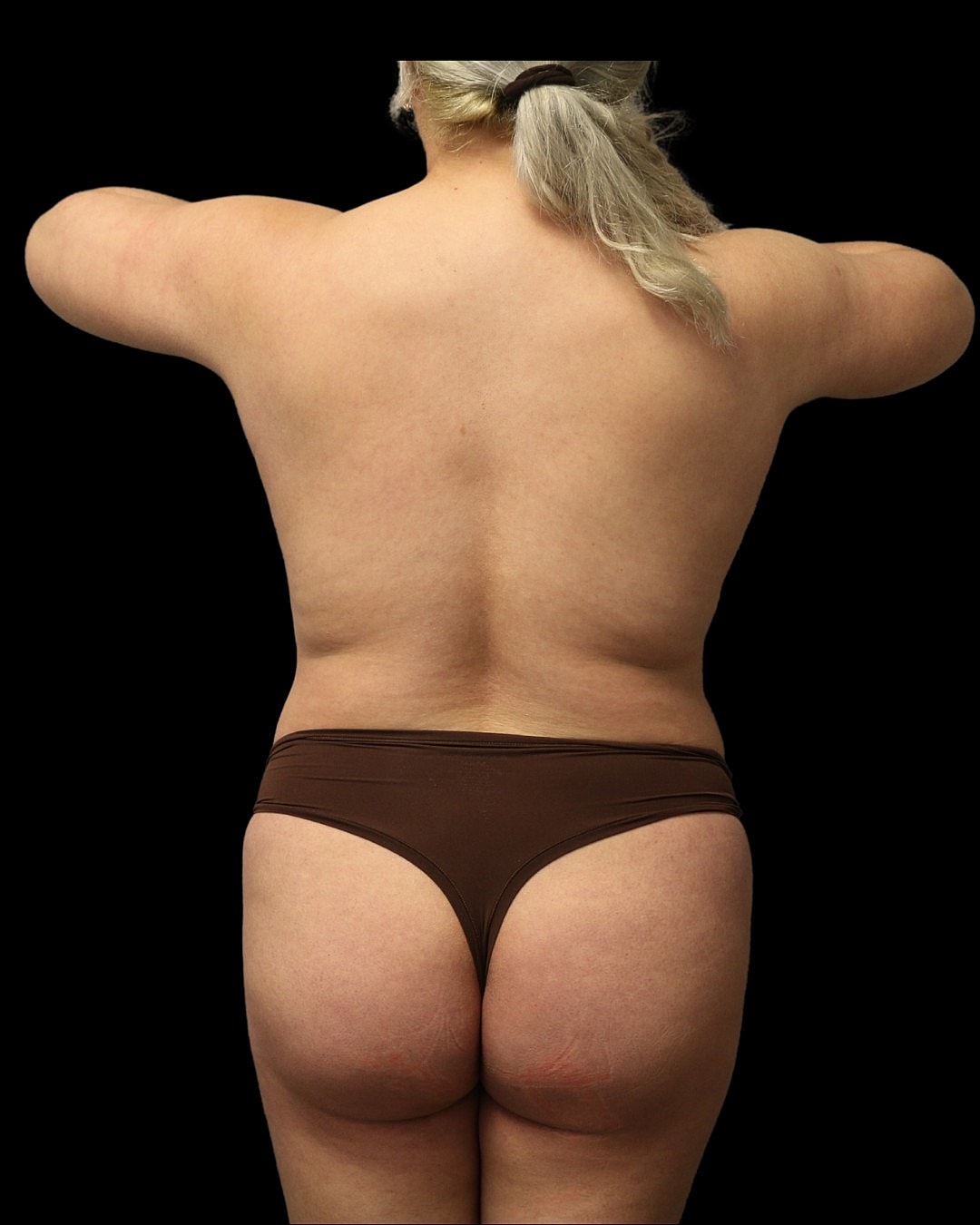 Liposuction Before & After