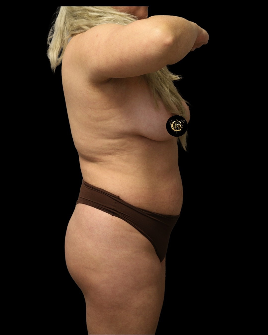 Liposuction Before & After
