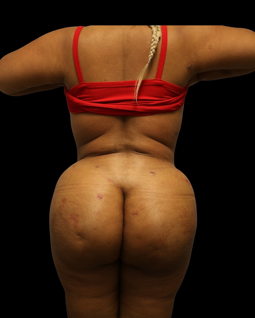 Liposuction Before & After