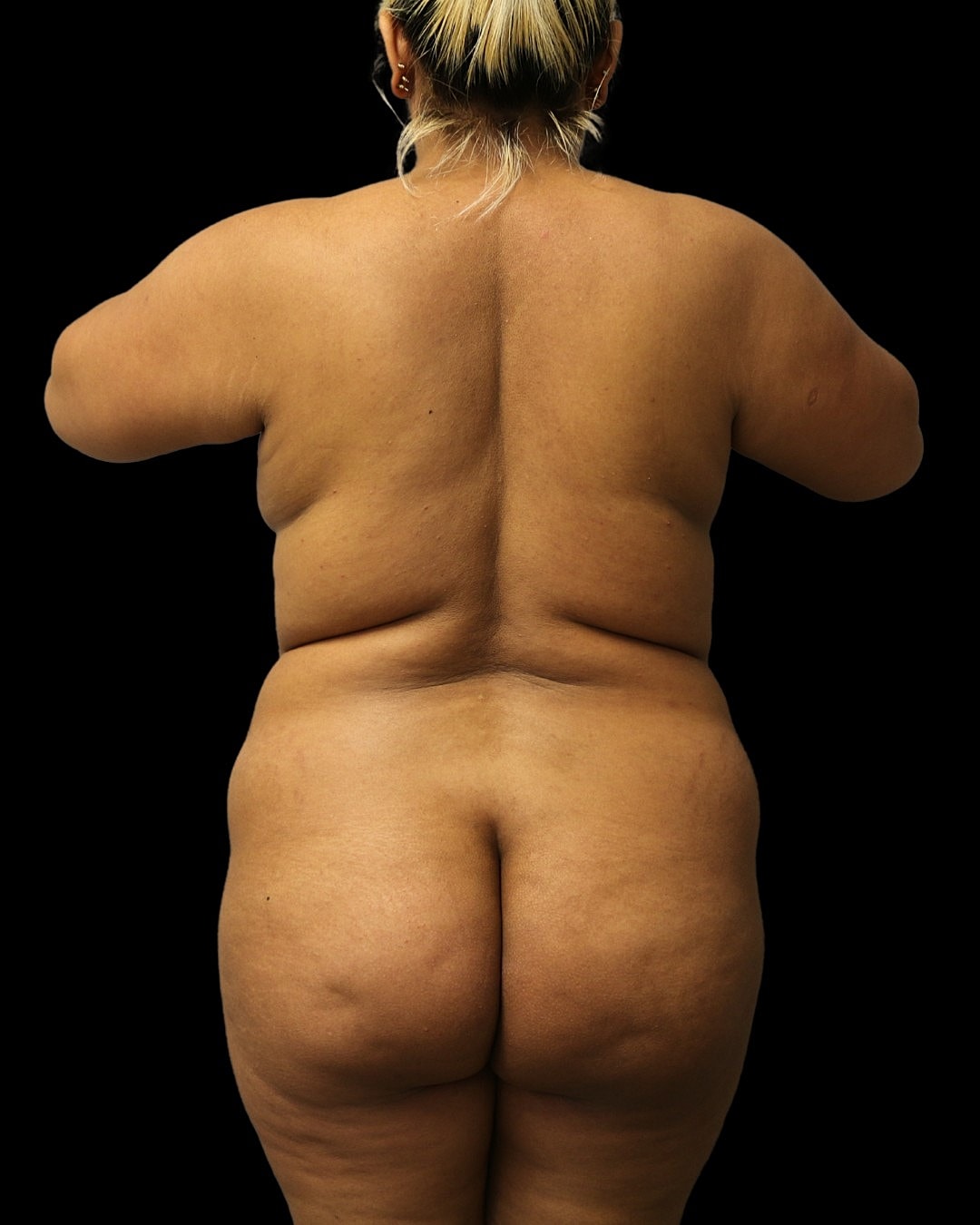 Liposuction Before & After