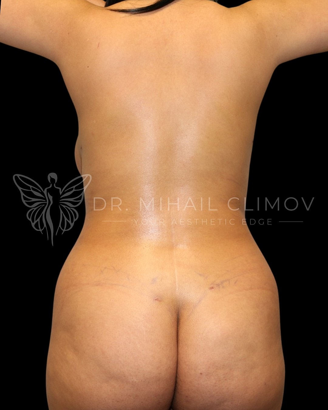 ase_001_after_behind.png After HD liposuction results – back view – Dr. Mihail Climov, Aesthetic Plastic Surgeon, Houston, TX