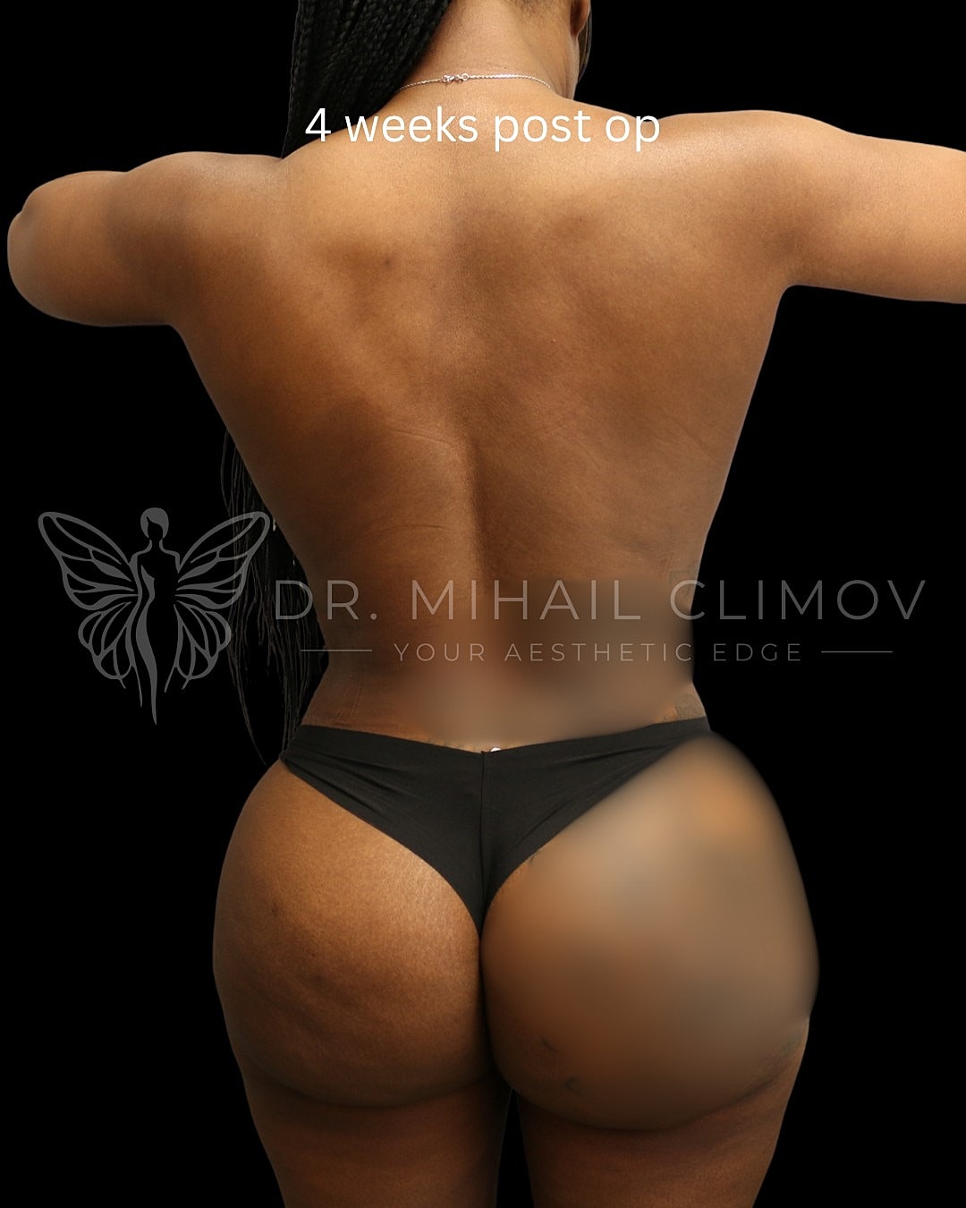 Case_014_after_back_after.png After 360 liposuction results at 4 weeks post-op – back view – Dr. Mihail Climov, Aesthetic Plastic Surgeon, Houston, TX