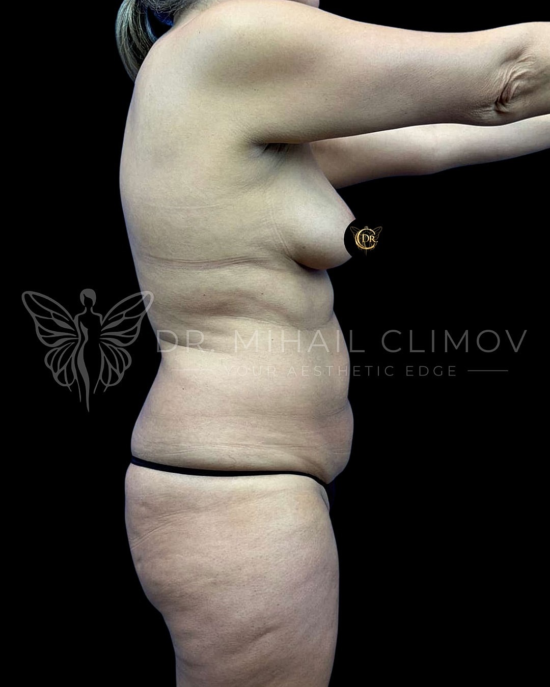 Before Vaser lipo 360 surgery – right side profile view – Dr. Mihail Climov, Aesthetic Plastic Surgeon, Houston, TX