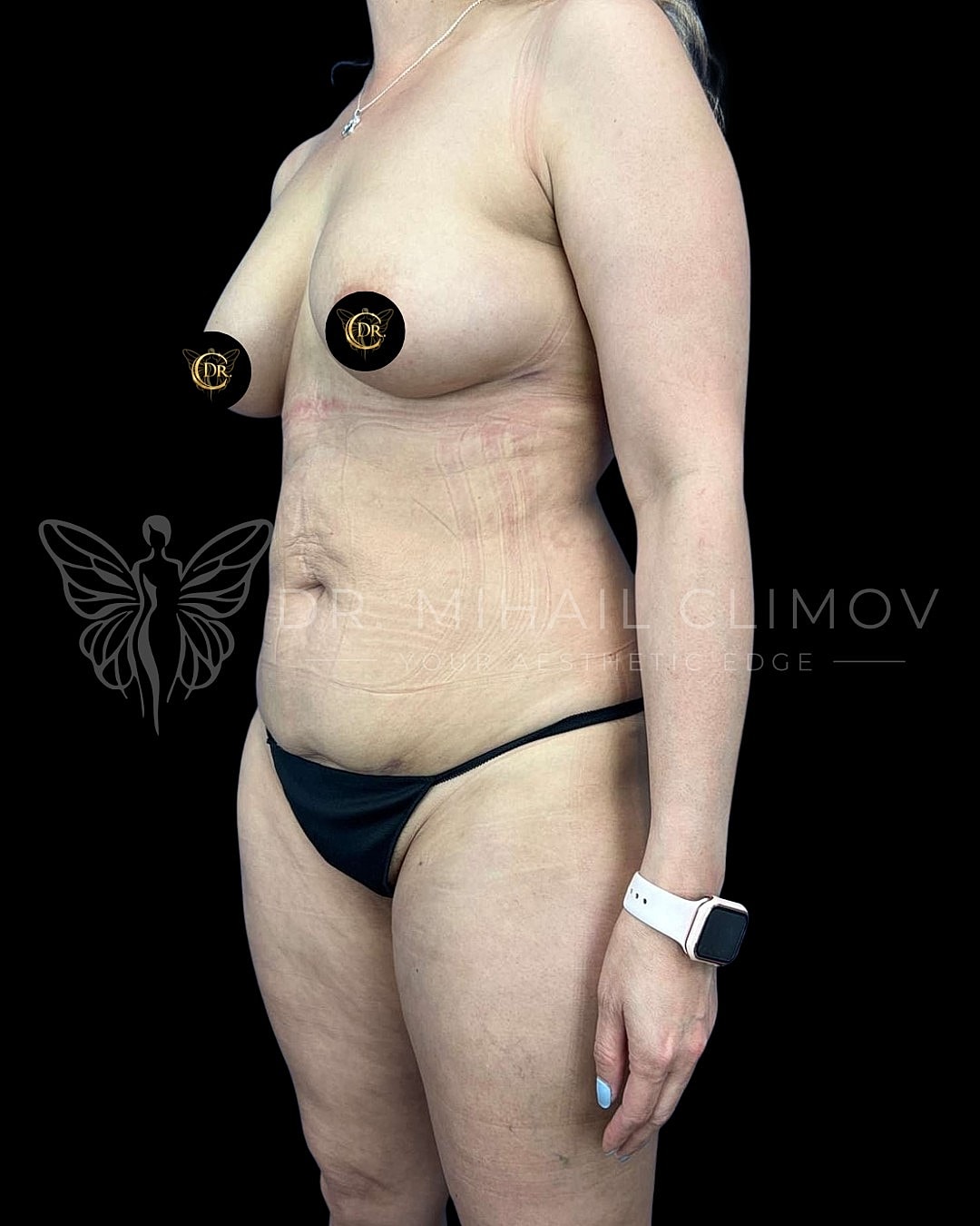 left 3/4 angle view – Dr. Mihail Climov, Aesthetic Plastic Surgeon, Houston, TX